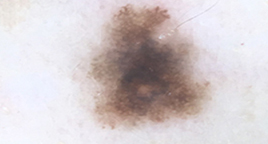 mole check by dermatologist